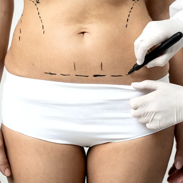img-abdominoplasty-pereira-1